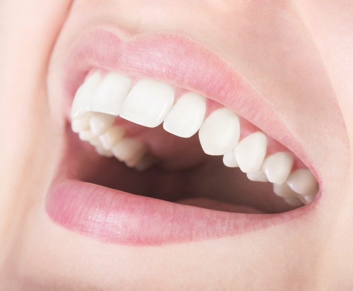美白貼片：能讓牙齒完整吸收美白成分
